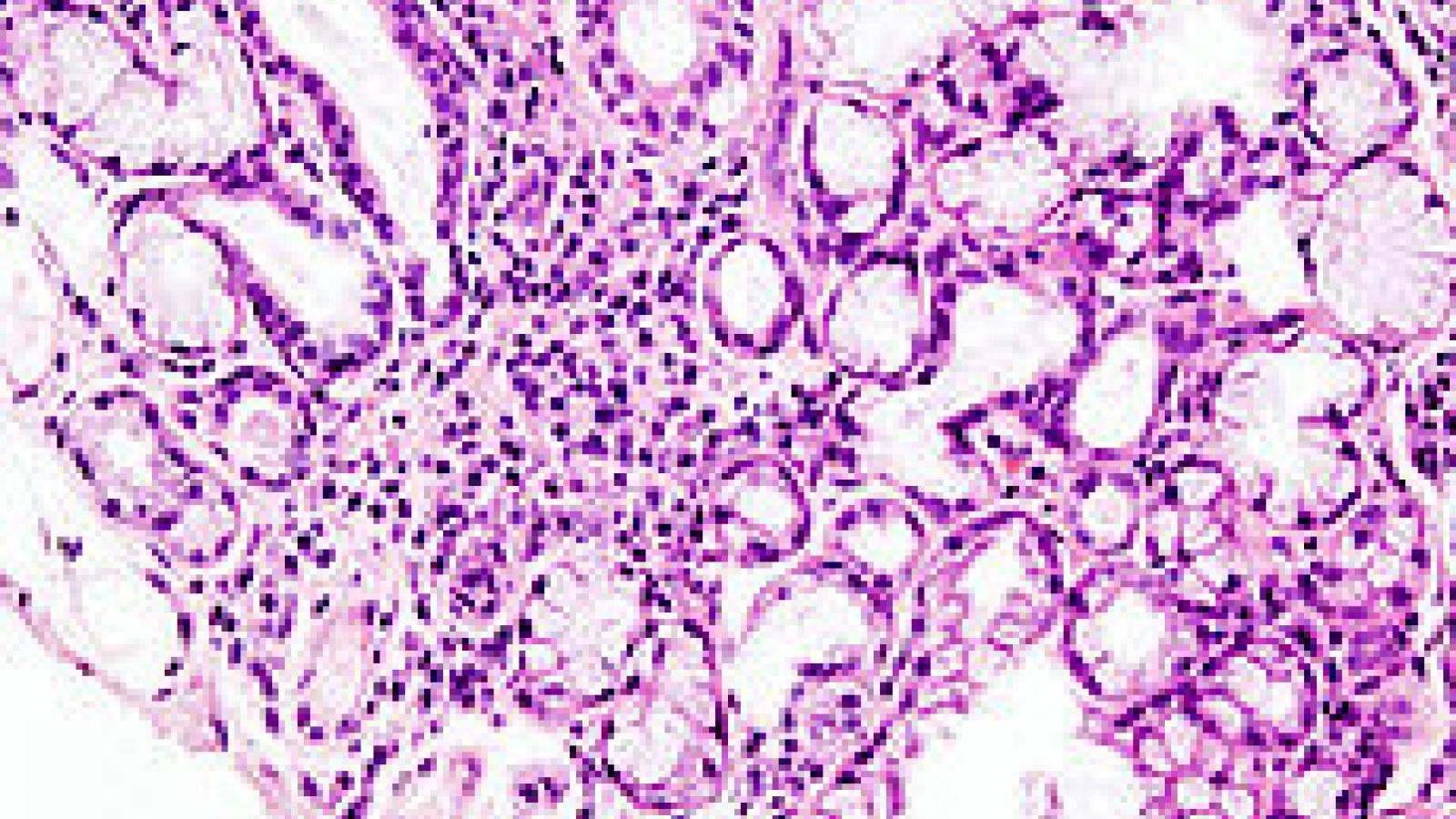 230px-Sjogren_syndrome_%282%29.jpg