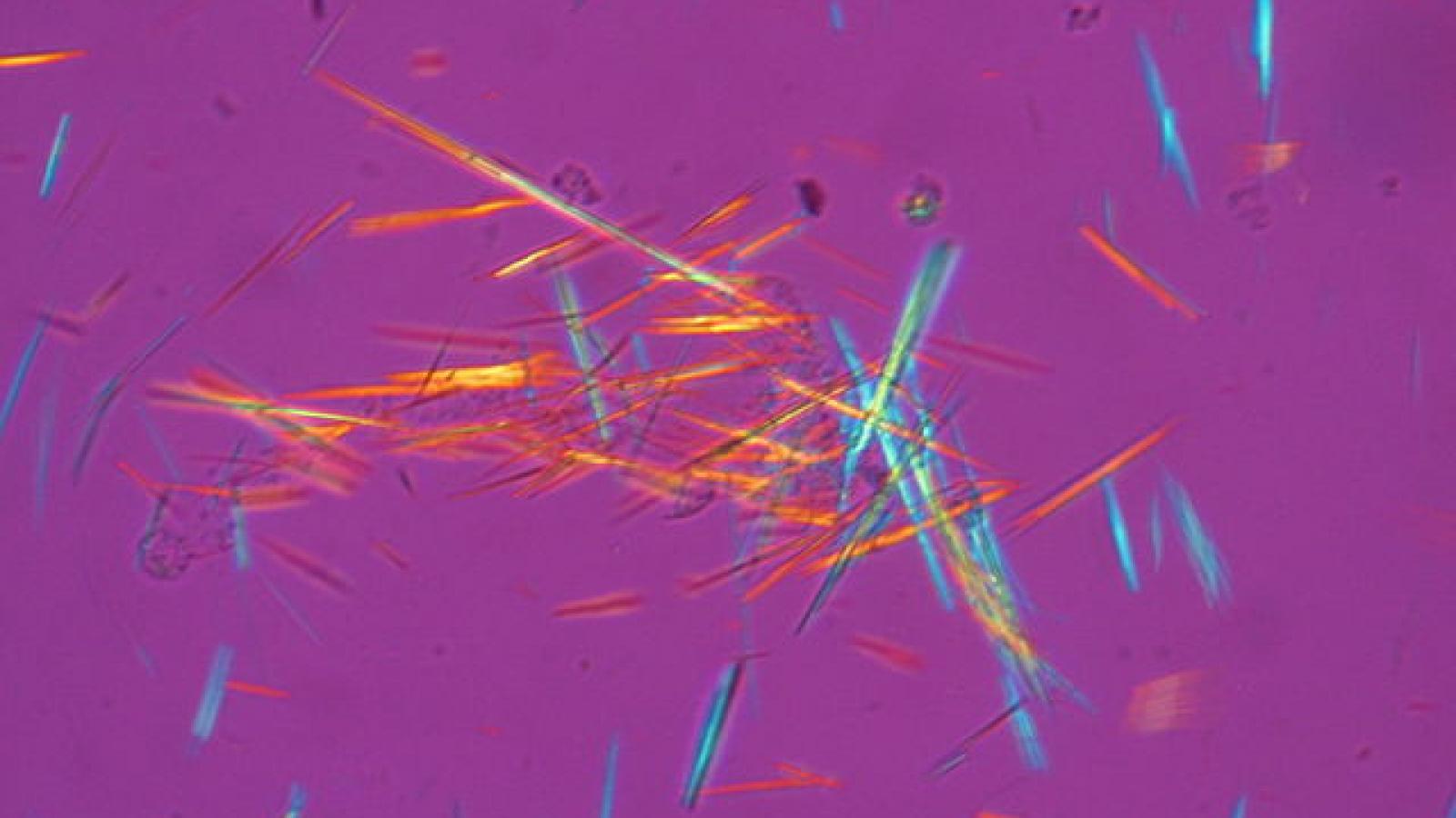640px-Fluorescent_uric_acid.JPG