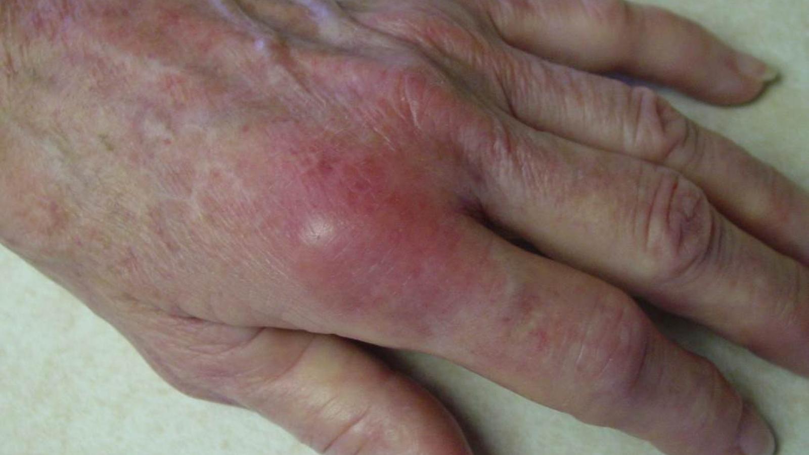Arthritis%20Flare1.jpg