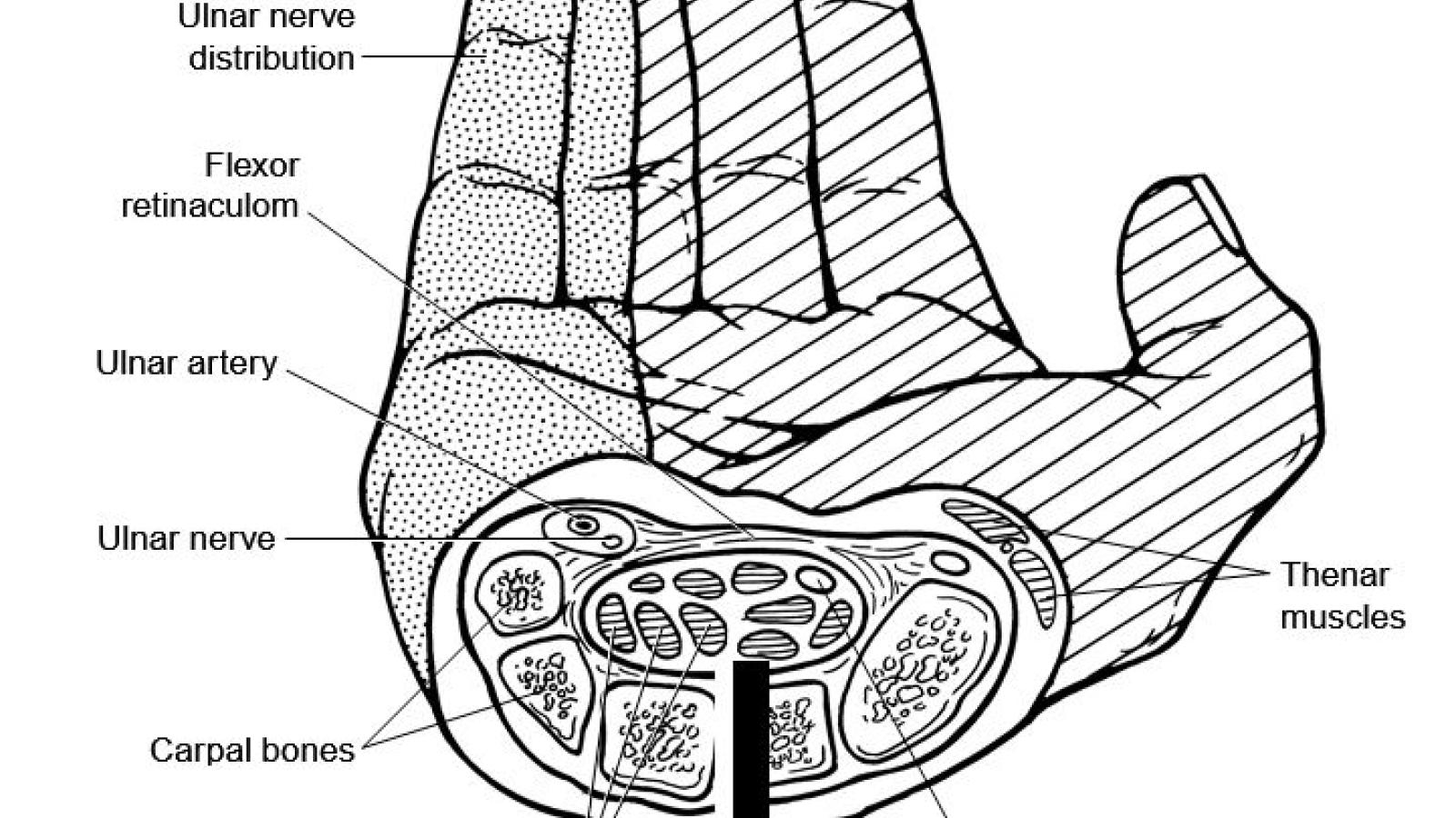 Carpal-Tunnel-Syndrome.jpg
