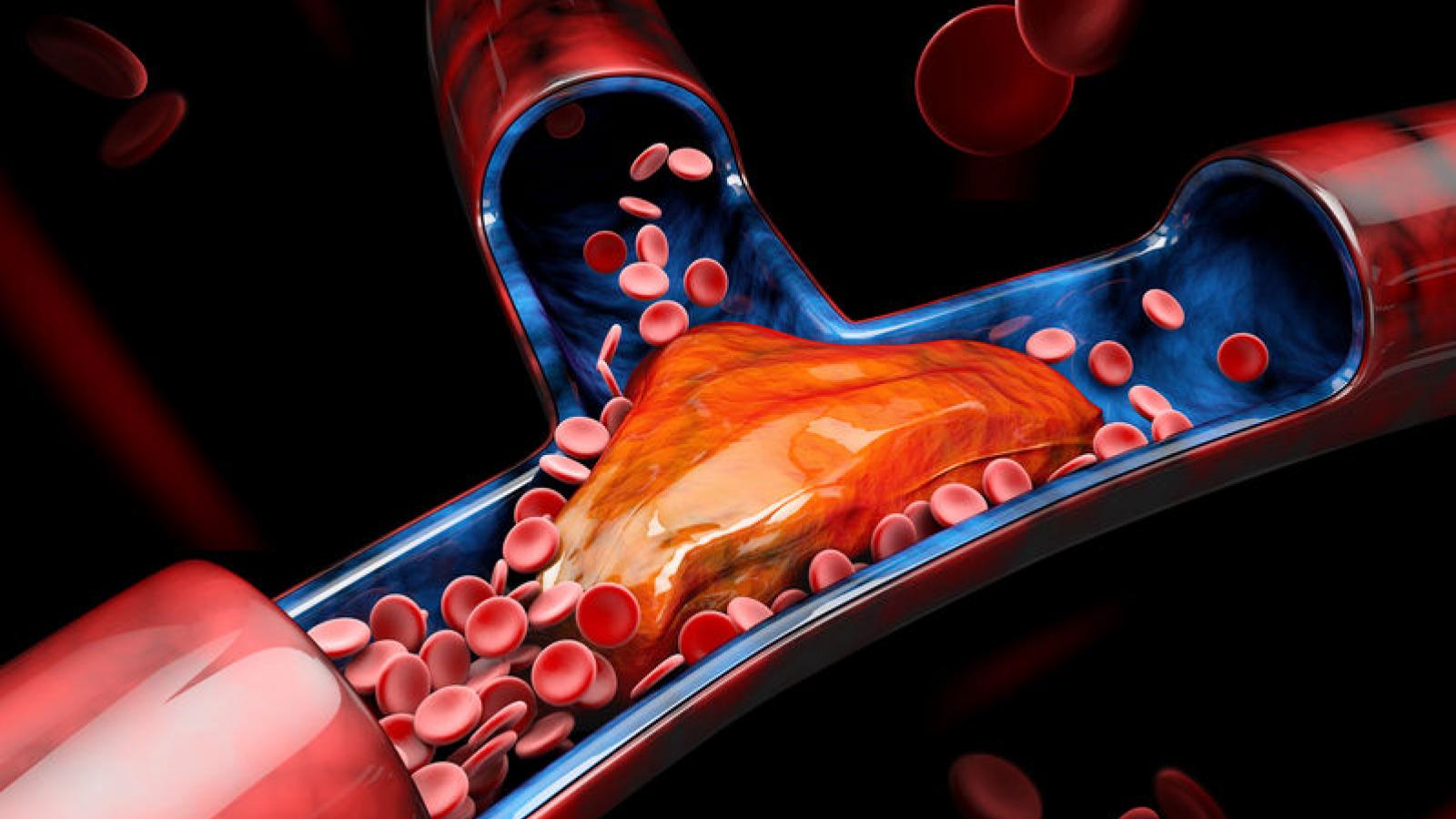 Clot.DVT_.VTE_.blood_.jpg