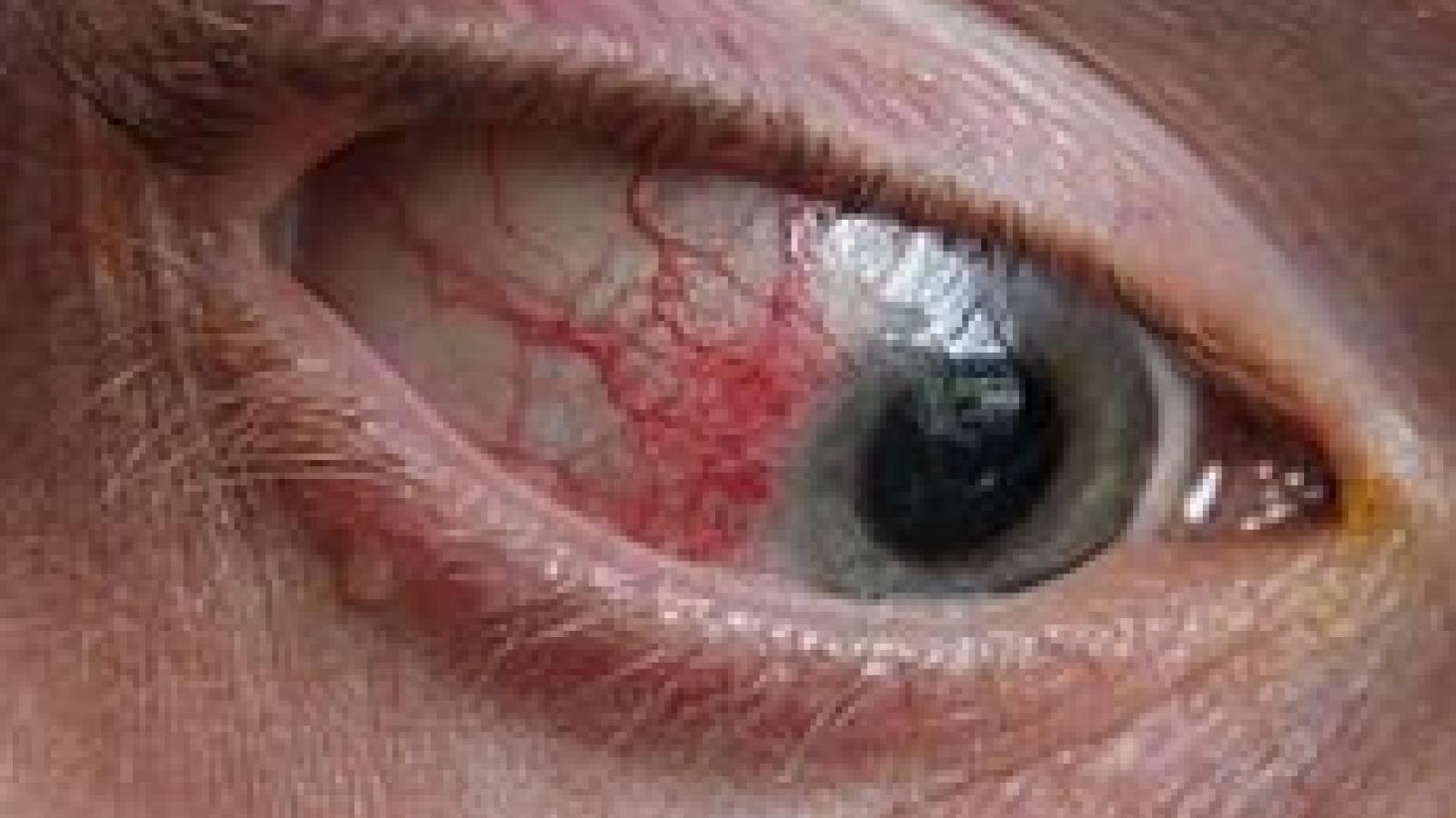 Episcleritiseye.jpg