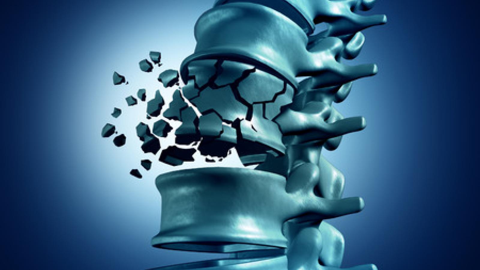 Fracture.spine_.op_.jpg (keep)