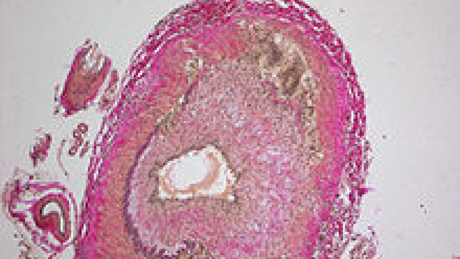 Giant-Cell_Vasculitis.jpg
