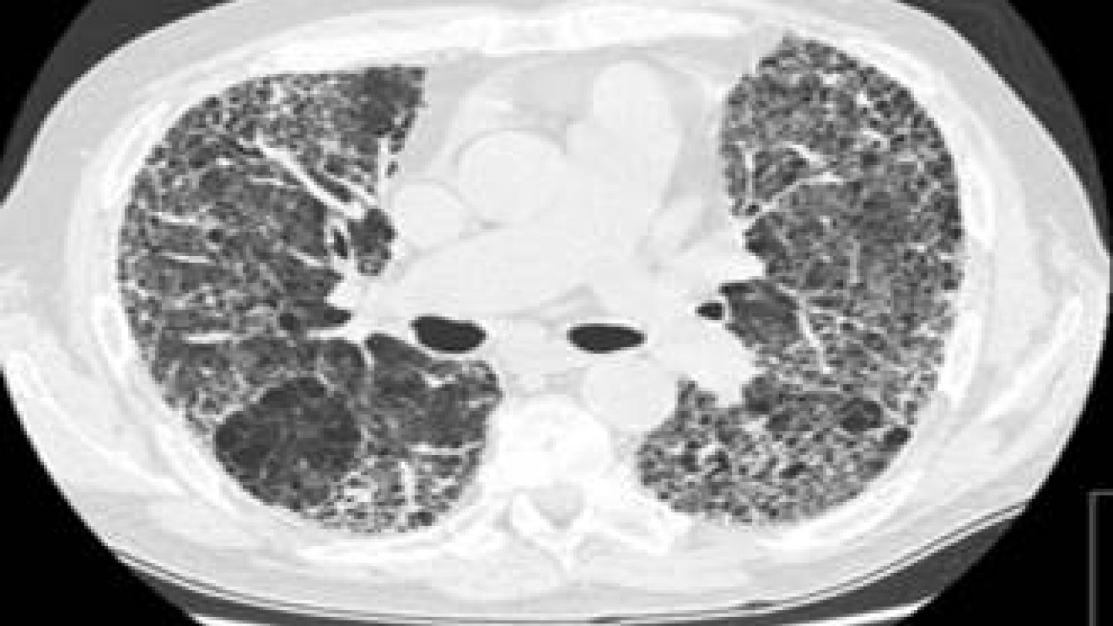 IPF.CT_.jpg