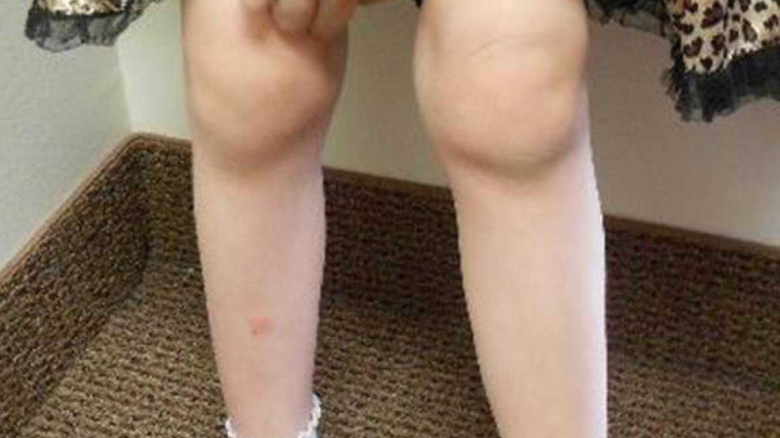 JIA.oligoarticular.jpg
