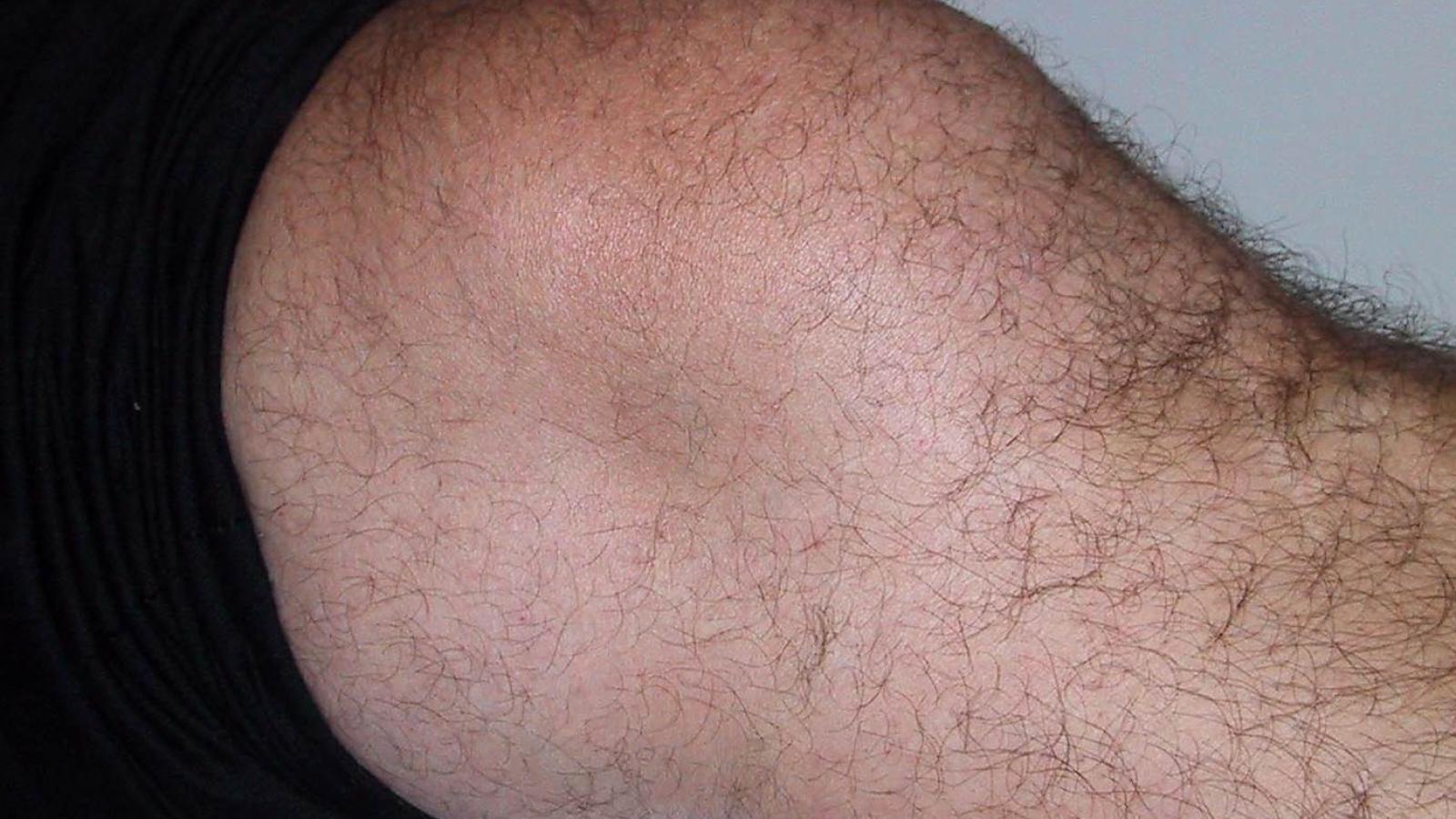 Knee.effusion.jpg