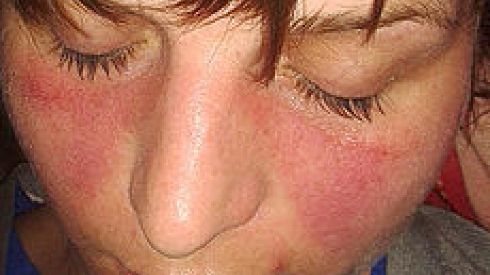 Lupusfoto.jpg