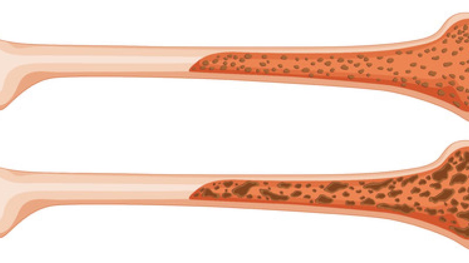 OP.Bone_.jpg