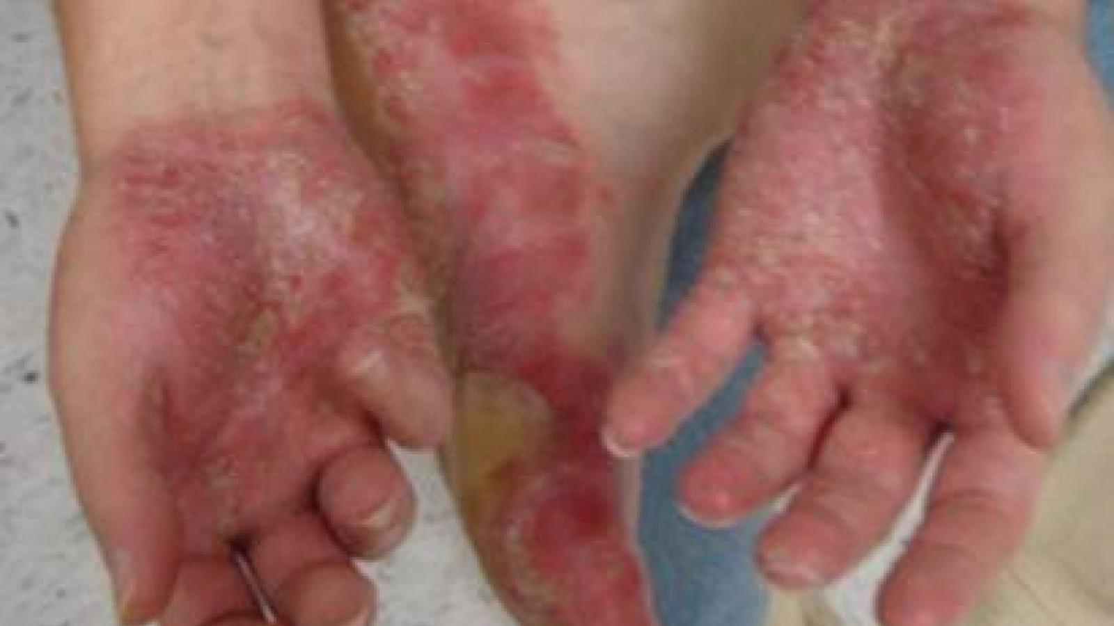 PSO.Palmoplantar.jpg