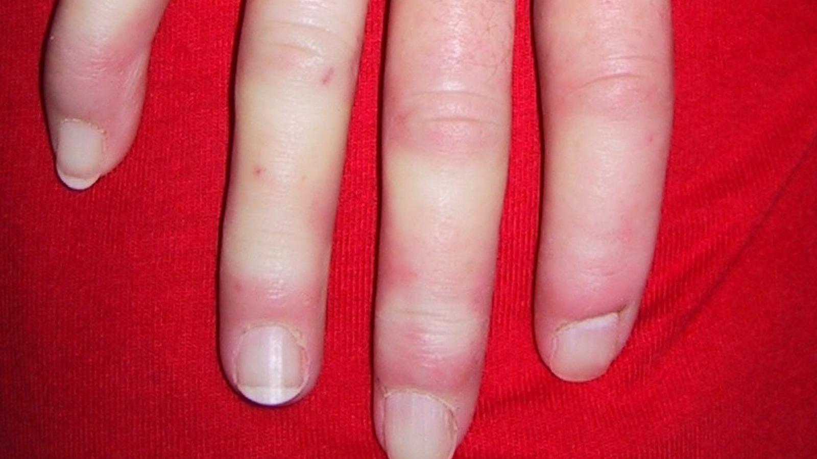 PSS.hands_.Raynauds.jpg (keep)