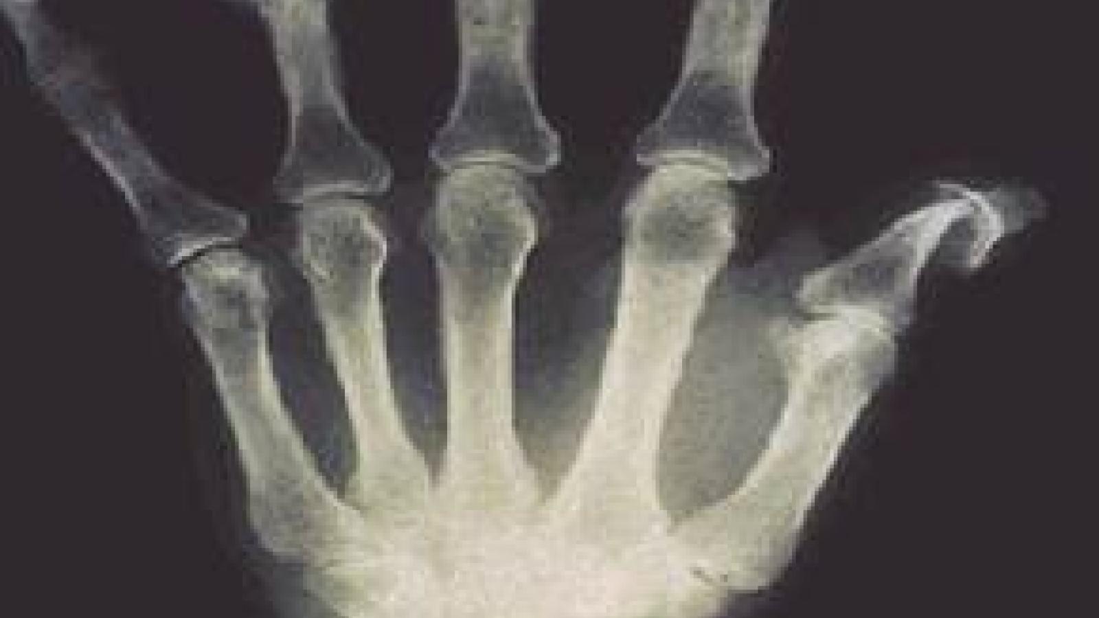 PsA.Xray_.Erosion.Cup_.jpg