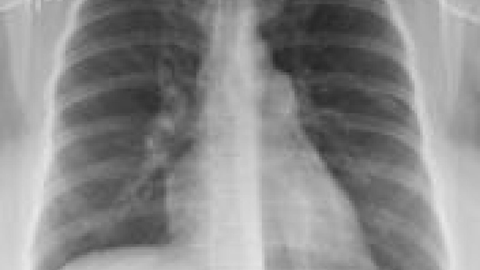 Pulm%20HTN.jpg