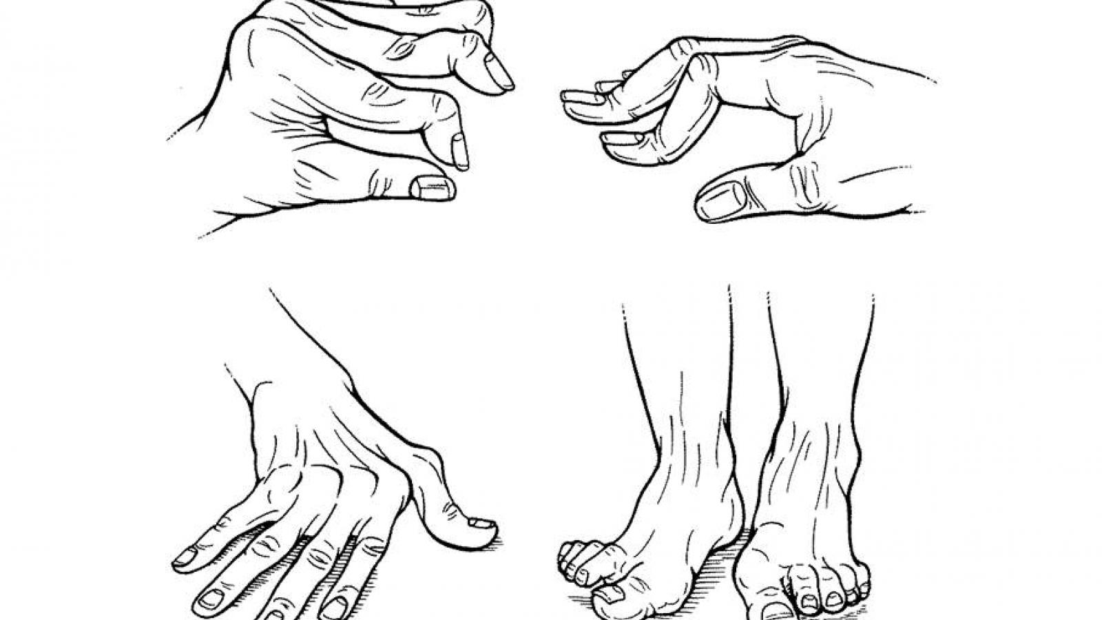 RA.Deformities.jpg