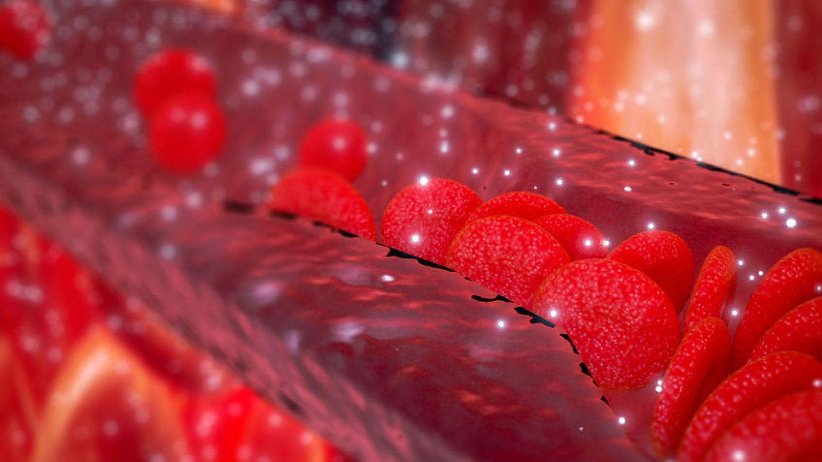 RA.vascular.cholesterol.plaque.jpg