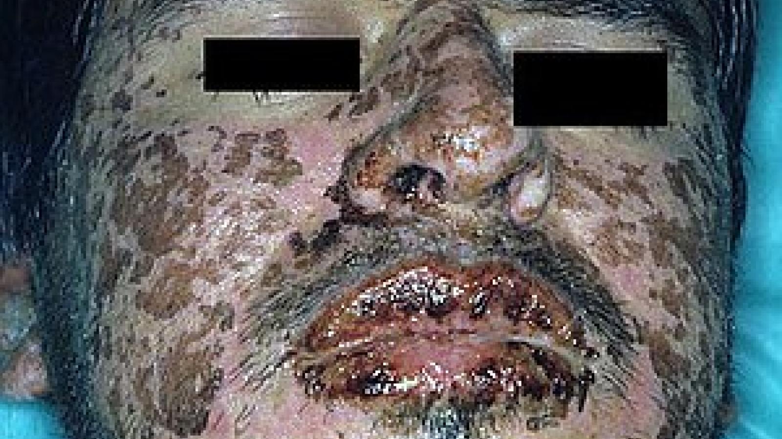 Stevens-johnson-syndrome.jpg