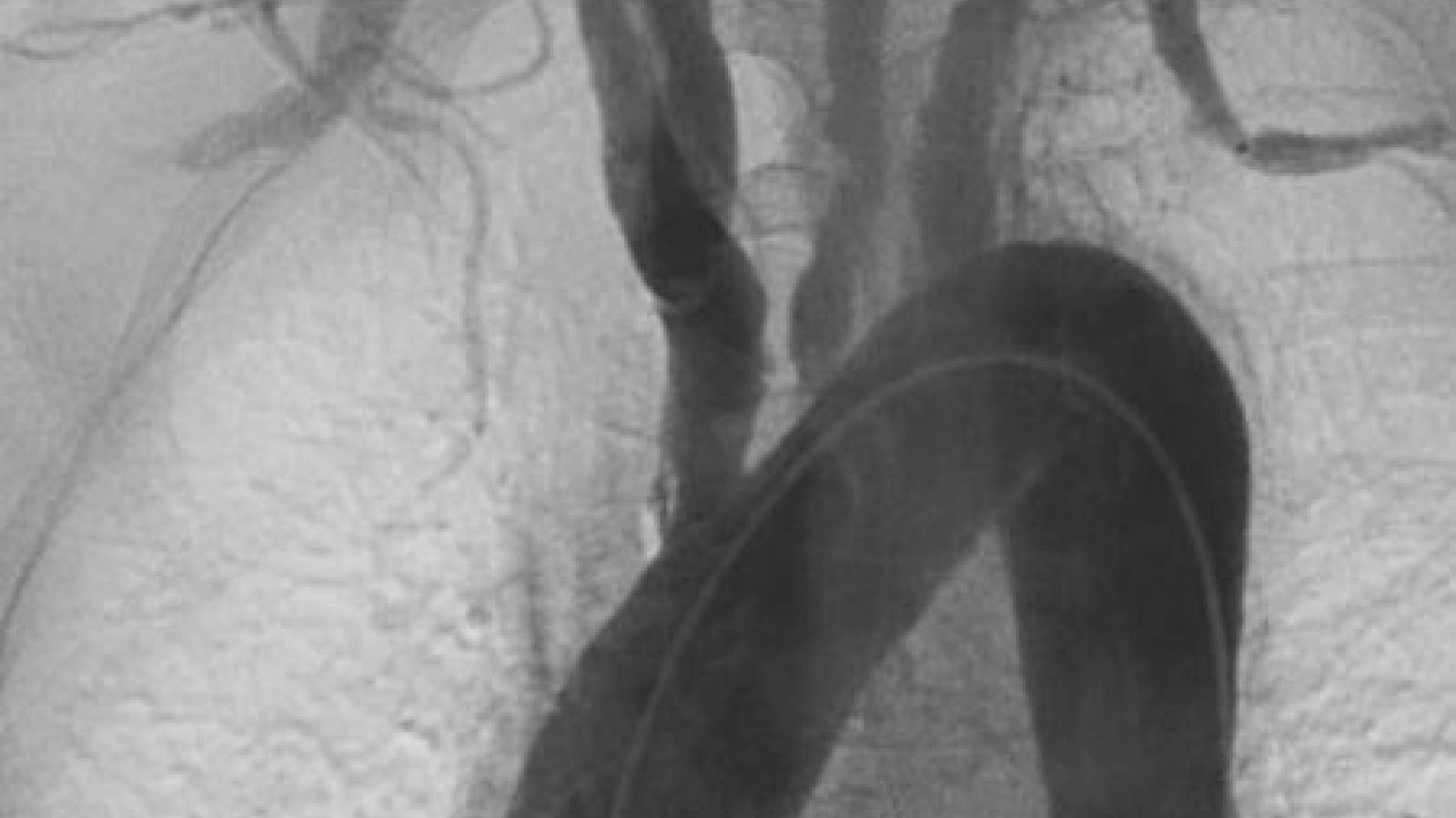 Takayasu_Arteritis.aortitis.jpg