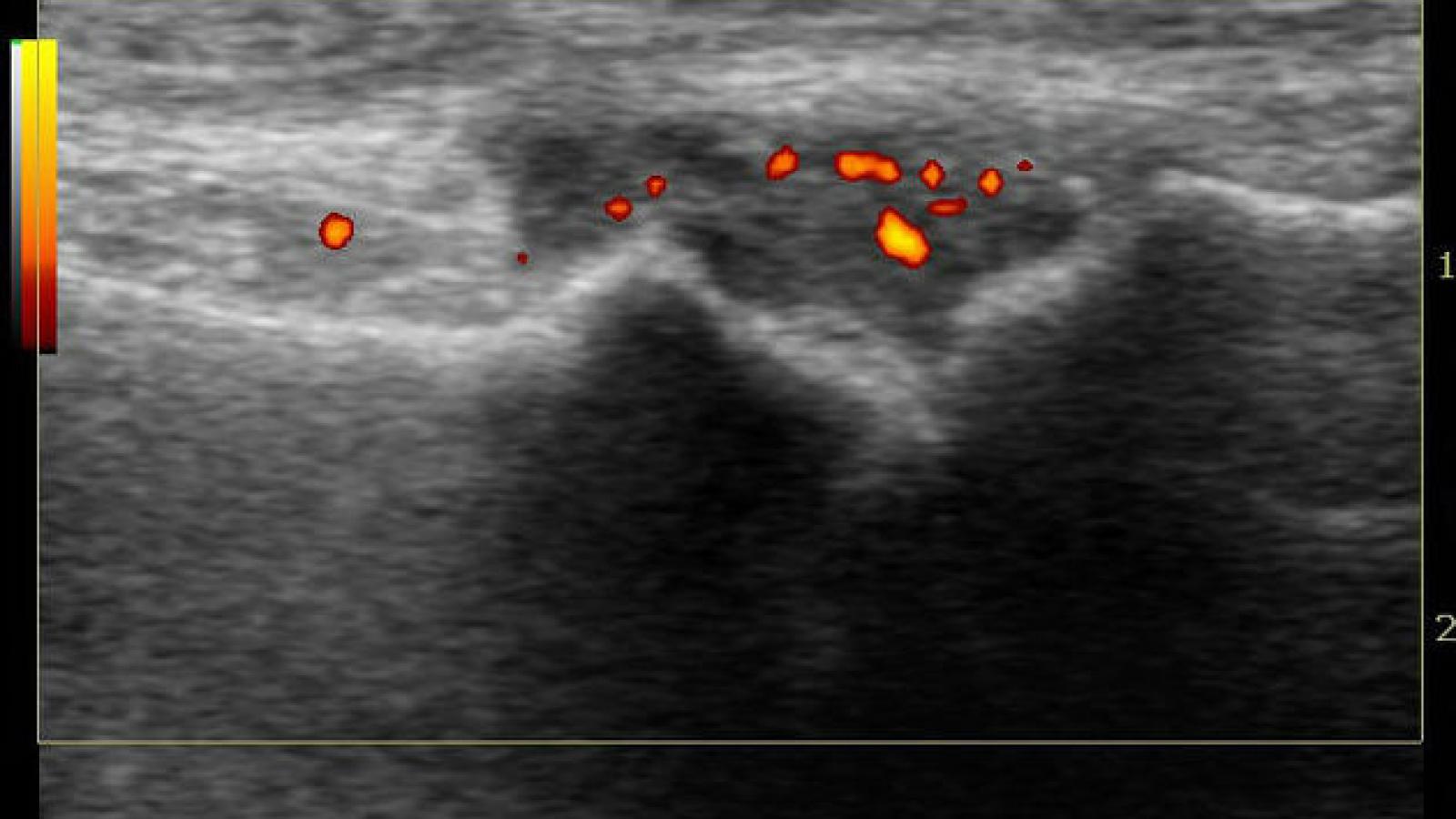US.MTP1_.synovitis.PD_.gout_.jpg