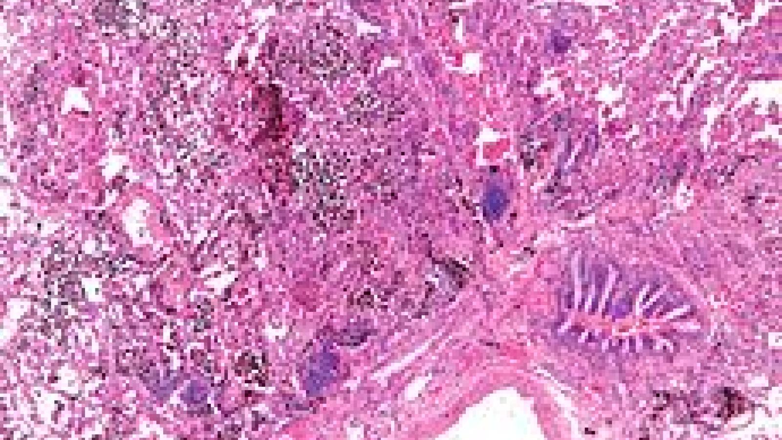 alveolar%20hemorrhage.wikipedia.jpg