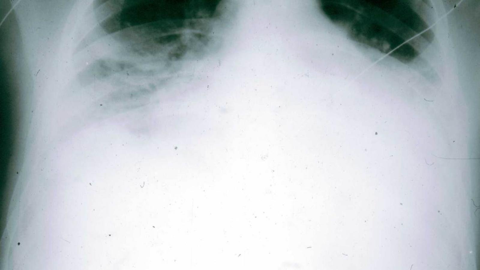 aosd.CXR_.jpg (keep)