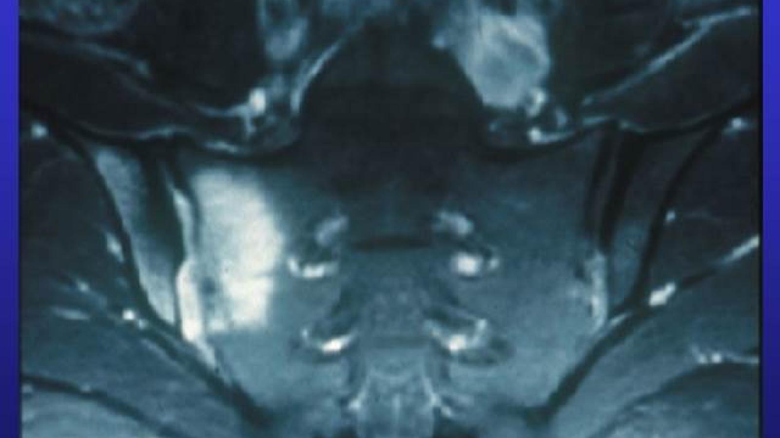 as.sacroiliitis.jpg