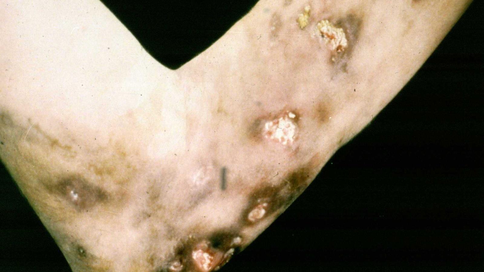 calcinosis.JPG