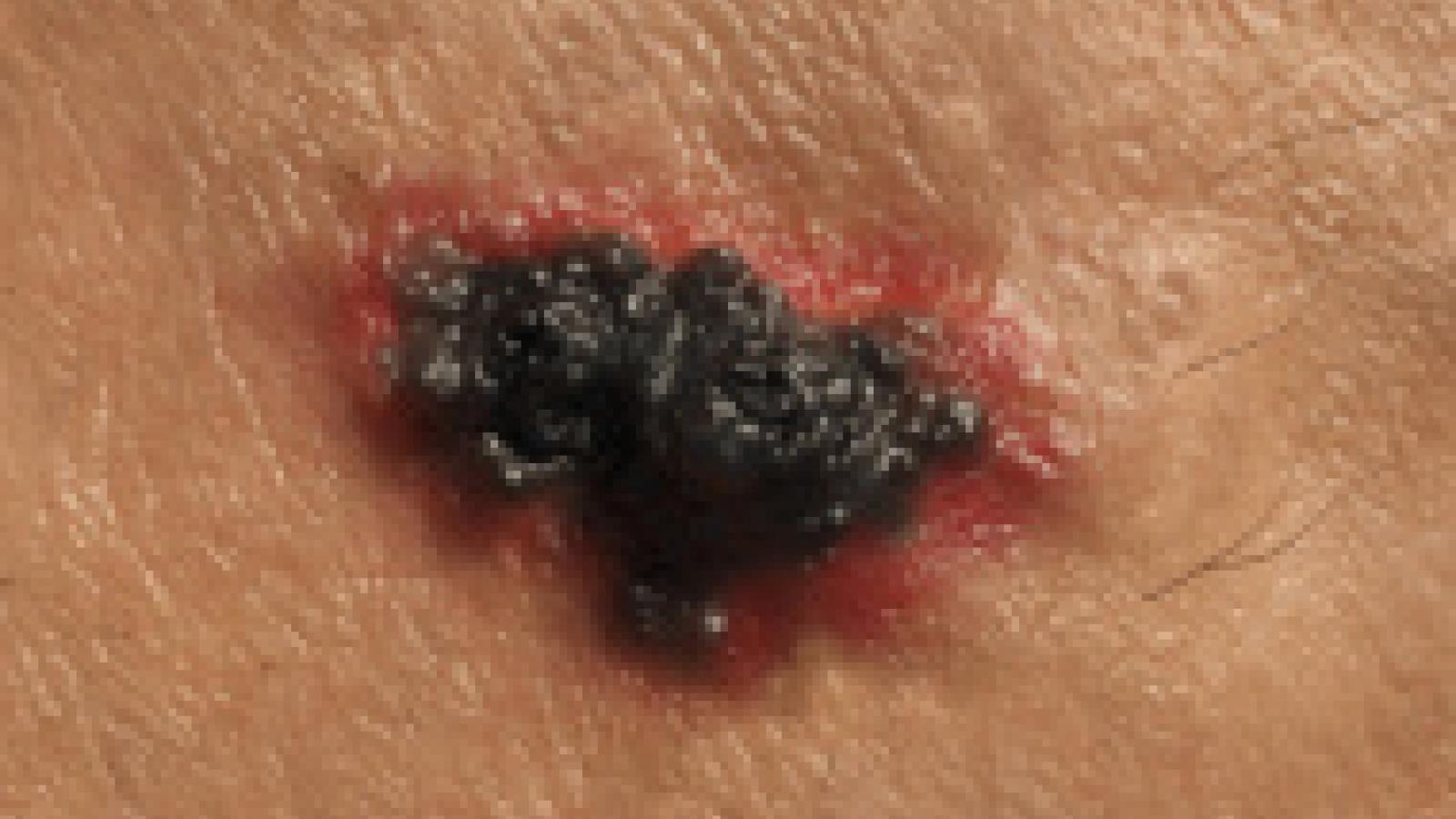 cancer.melanoma.jpg