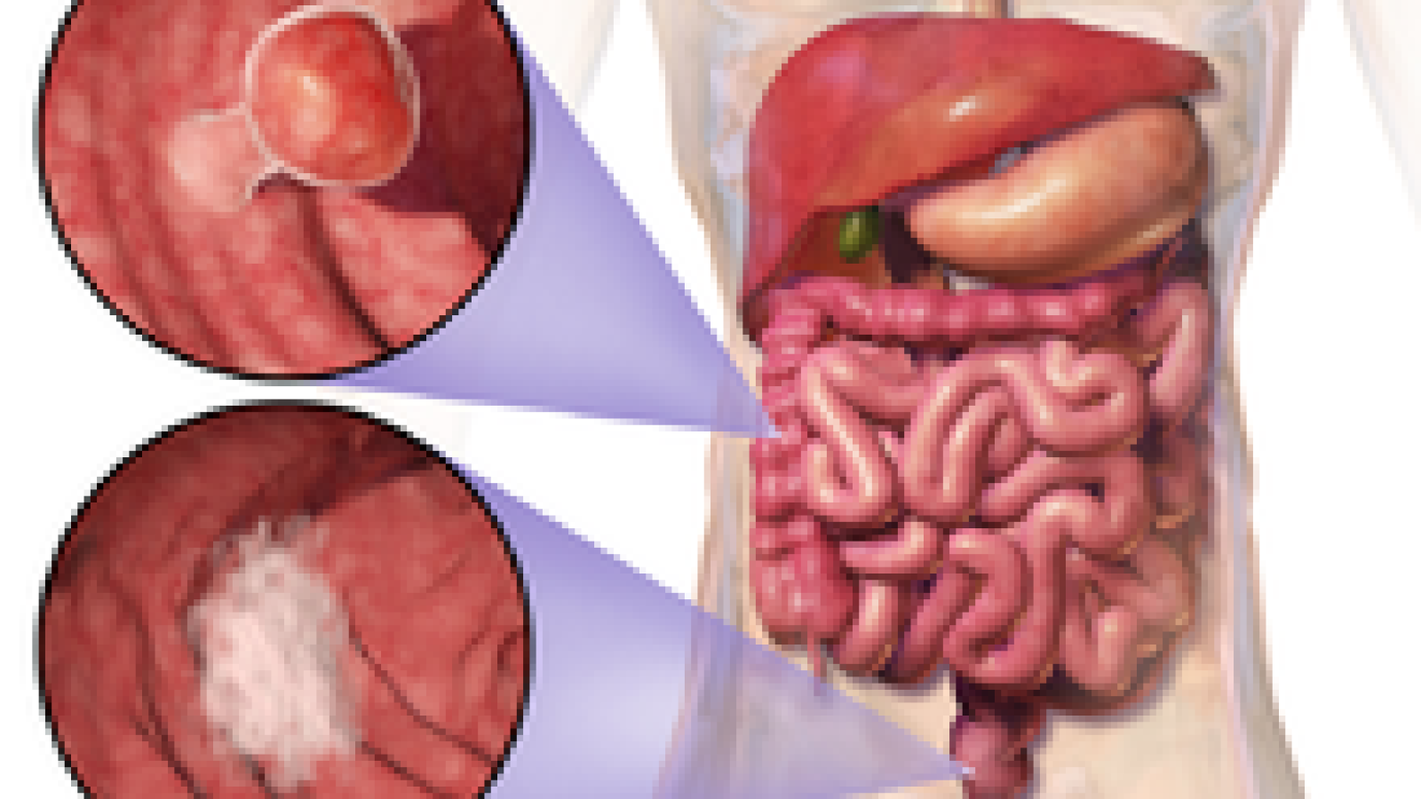 colon%20cancer.png