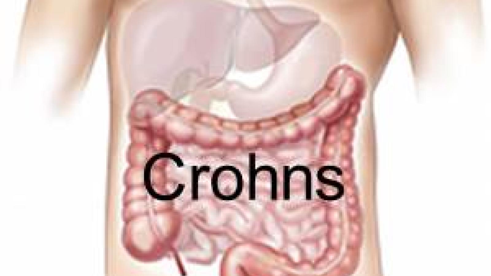 colon.Crohns.jpg