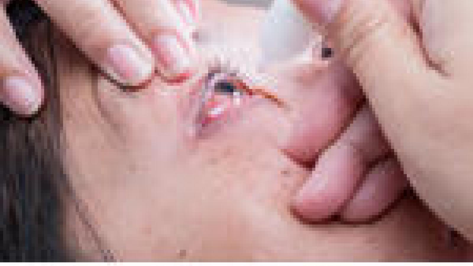 conjunctivitis-eyes-216074398.jpg