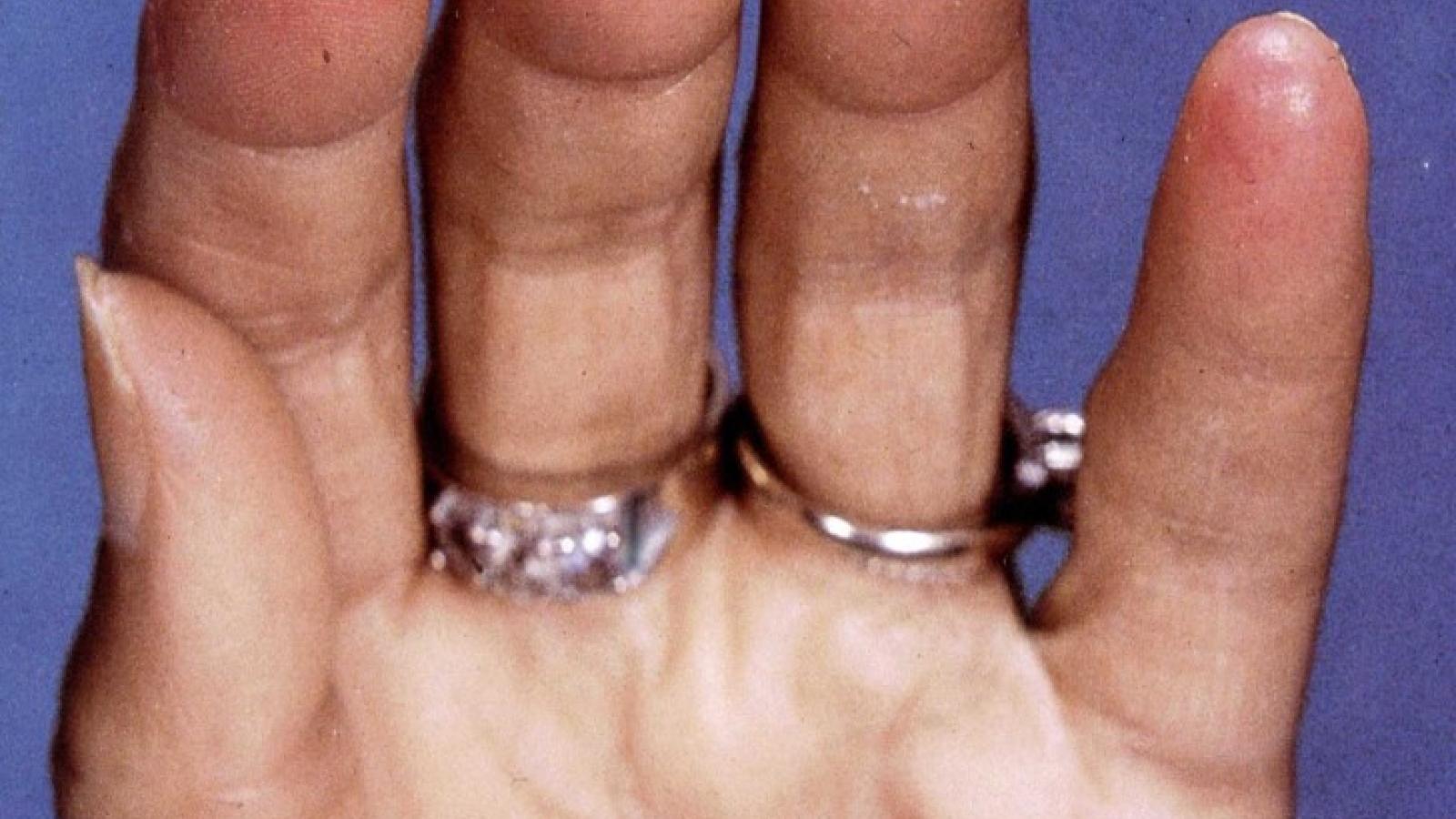 digit.ulcer_.jpg