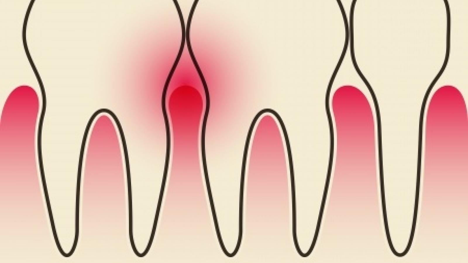 gingivitis_0.jpg