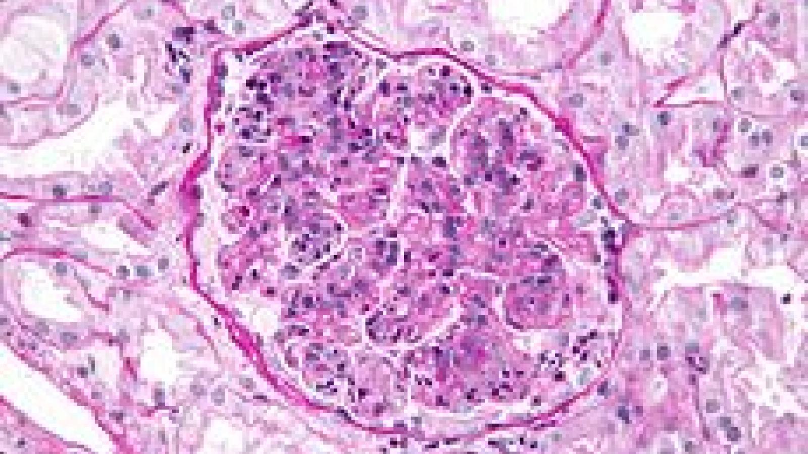 glomerulonephritis.jpg