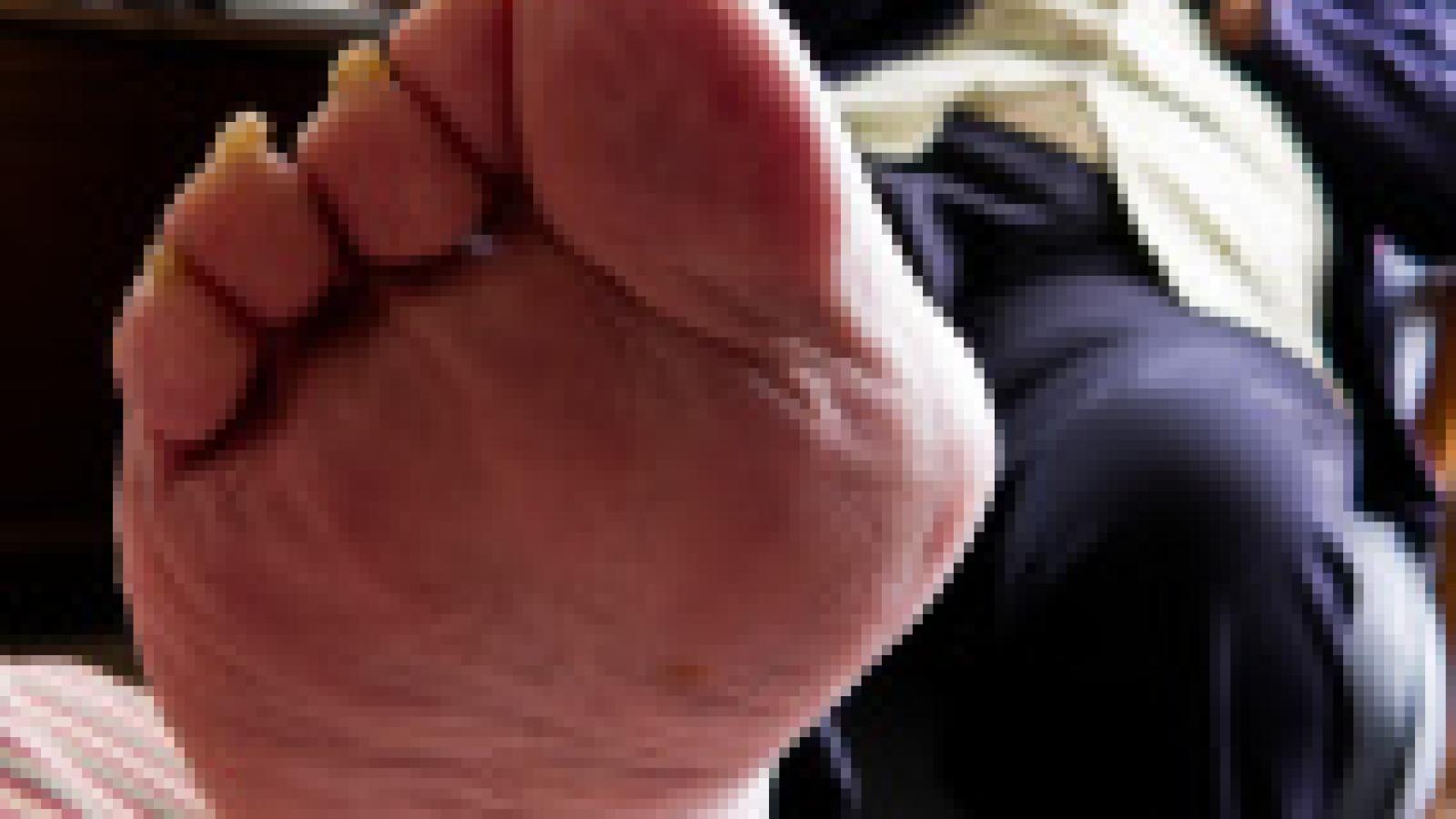 gout.bunion.jpg