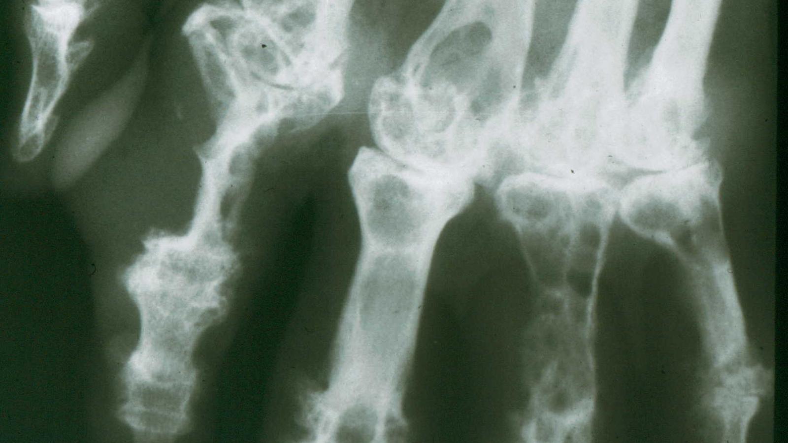 gout.erosivehand.jpg