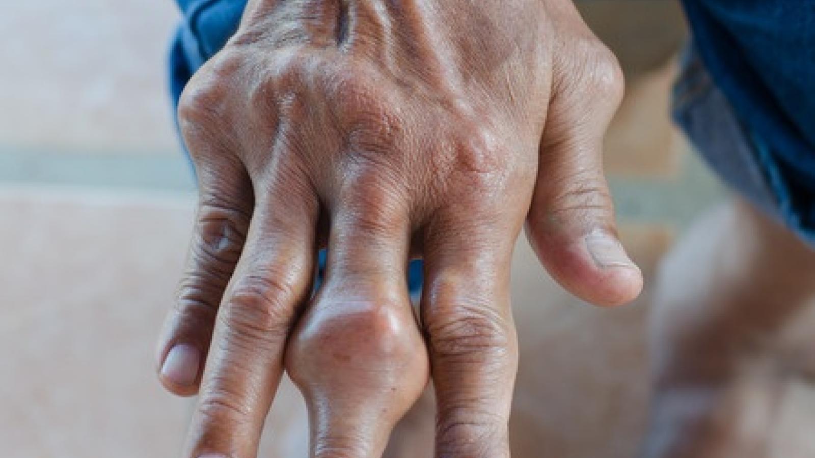 gout.hand_.jpg