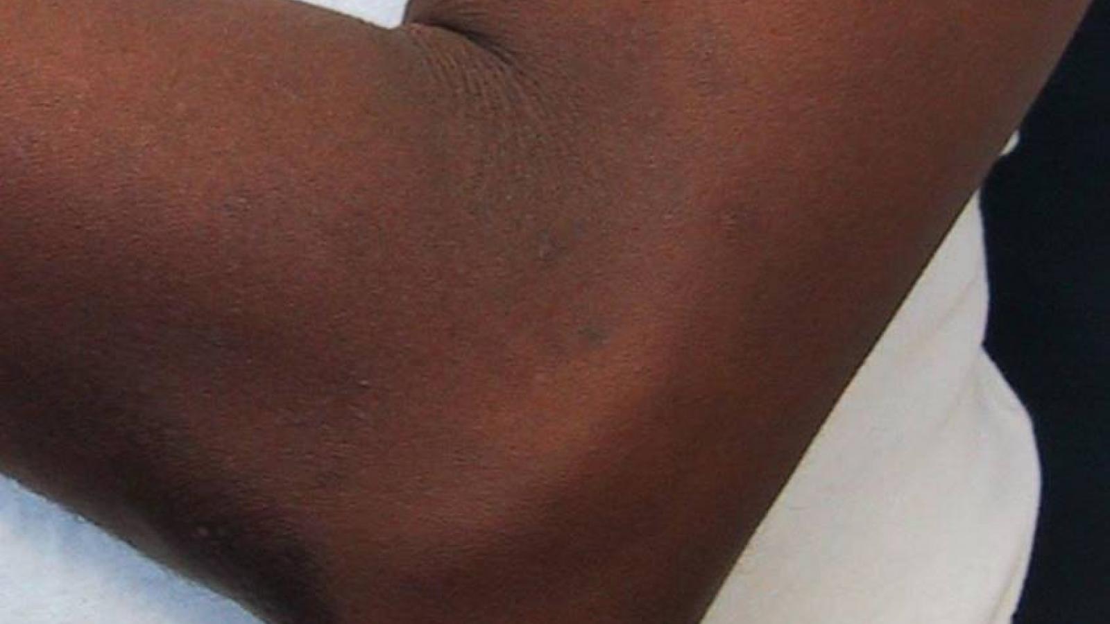 gout.olecranon.jpg