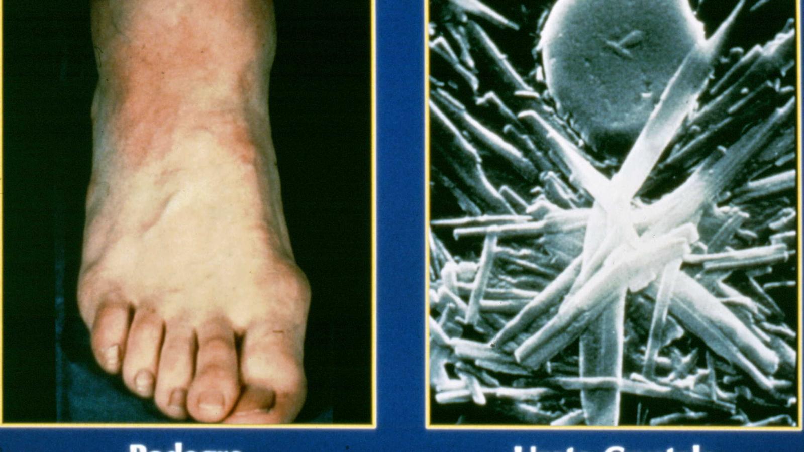 gout.podag1__1.jpg
