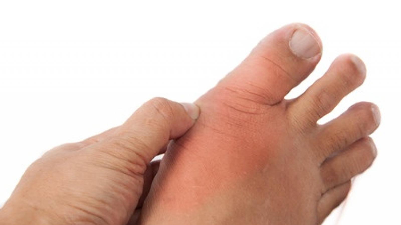 gout.podagra_0.jpg