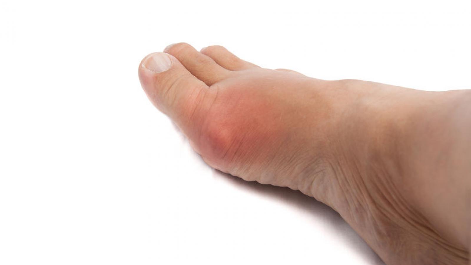 gout.toe_.MTP_.jpg