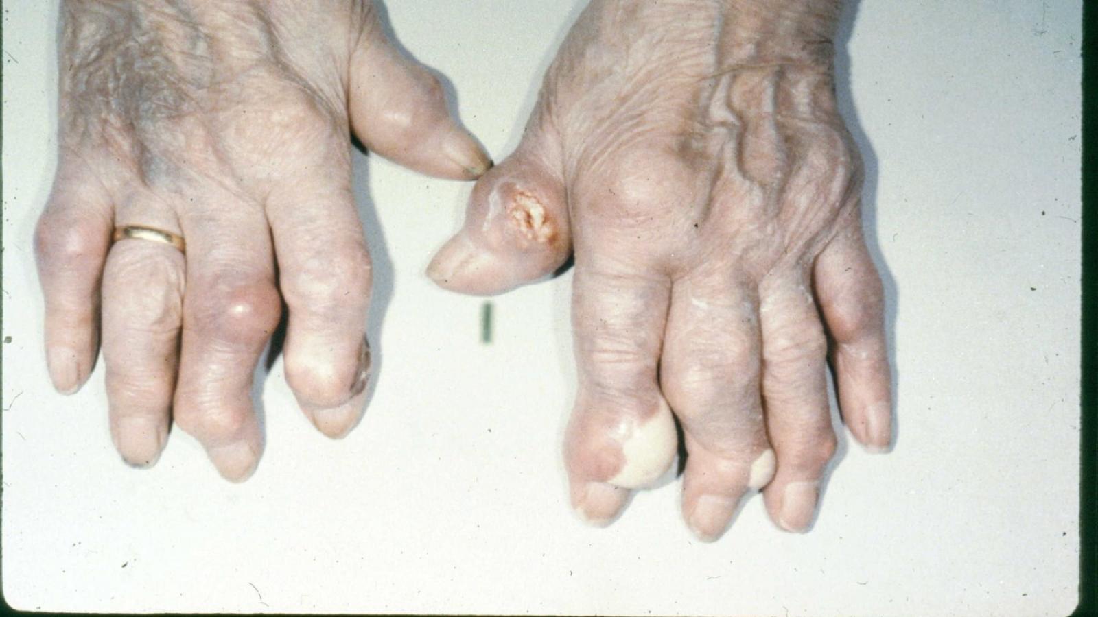 gout.tophi_.jpg