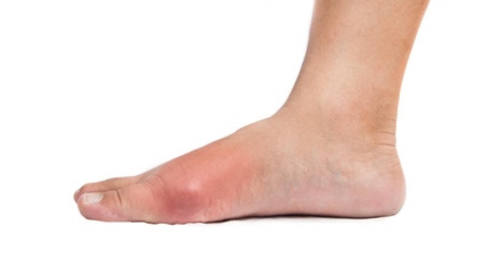 gout_s.jpg