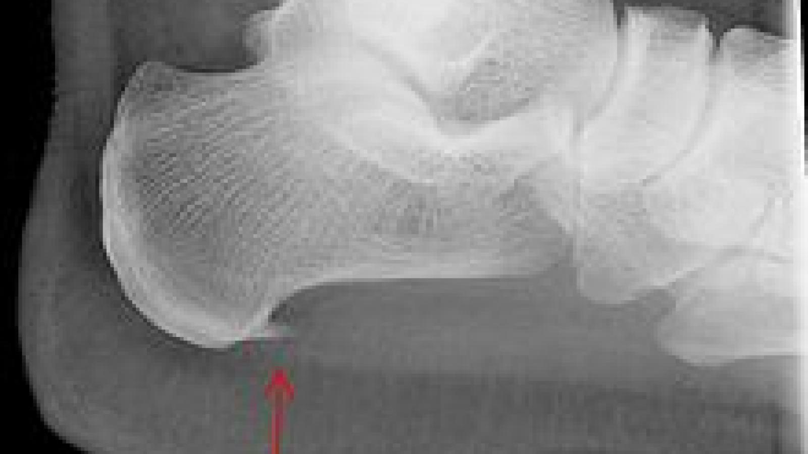 heel%20xray.jpg (keep)