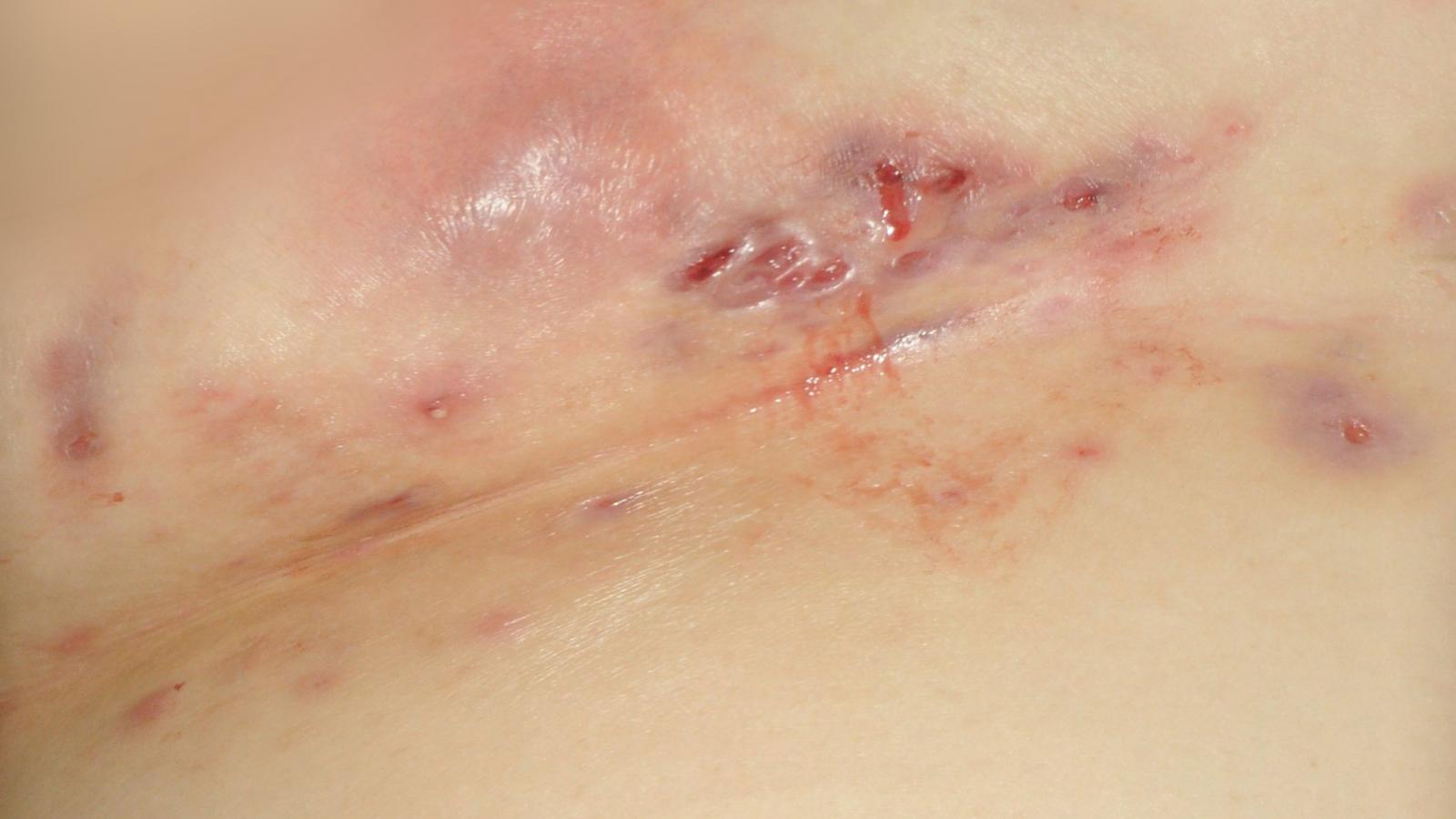 hidradenitis.jpg