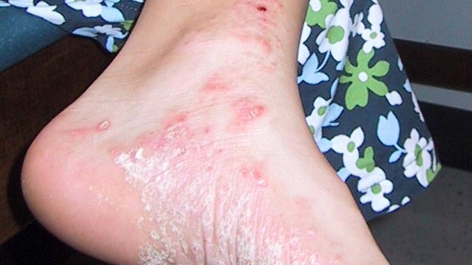 hudsonpsoriasis.jpg