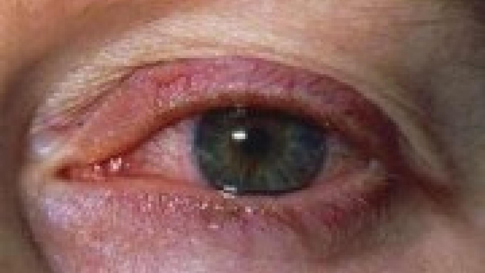 iritis-uveitis-e1333867439592.jpg