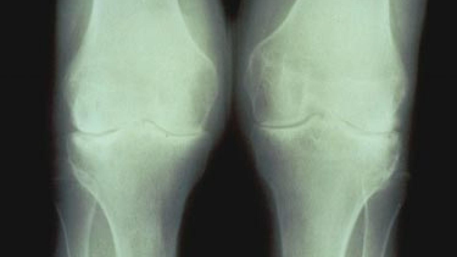 knee2_0.JPG (keep)