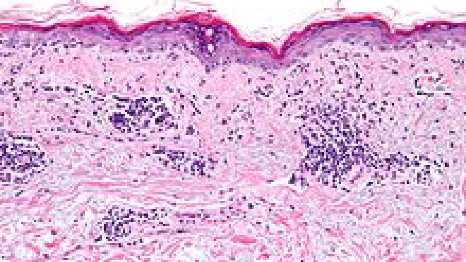 lupus.skinbx.jpg
