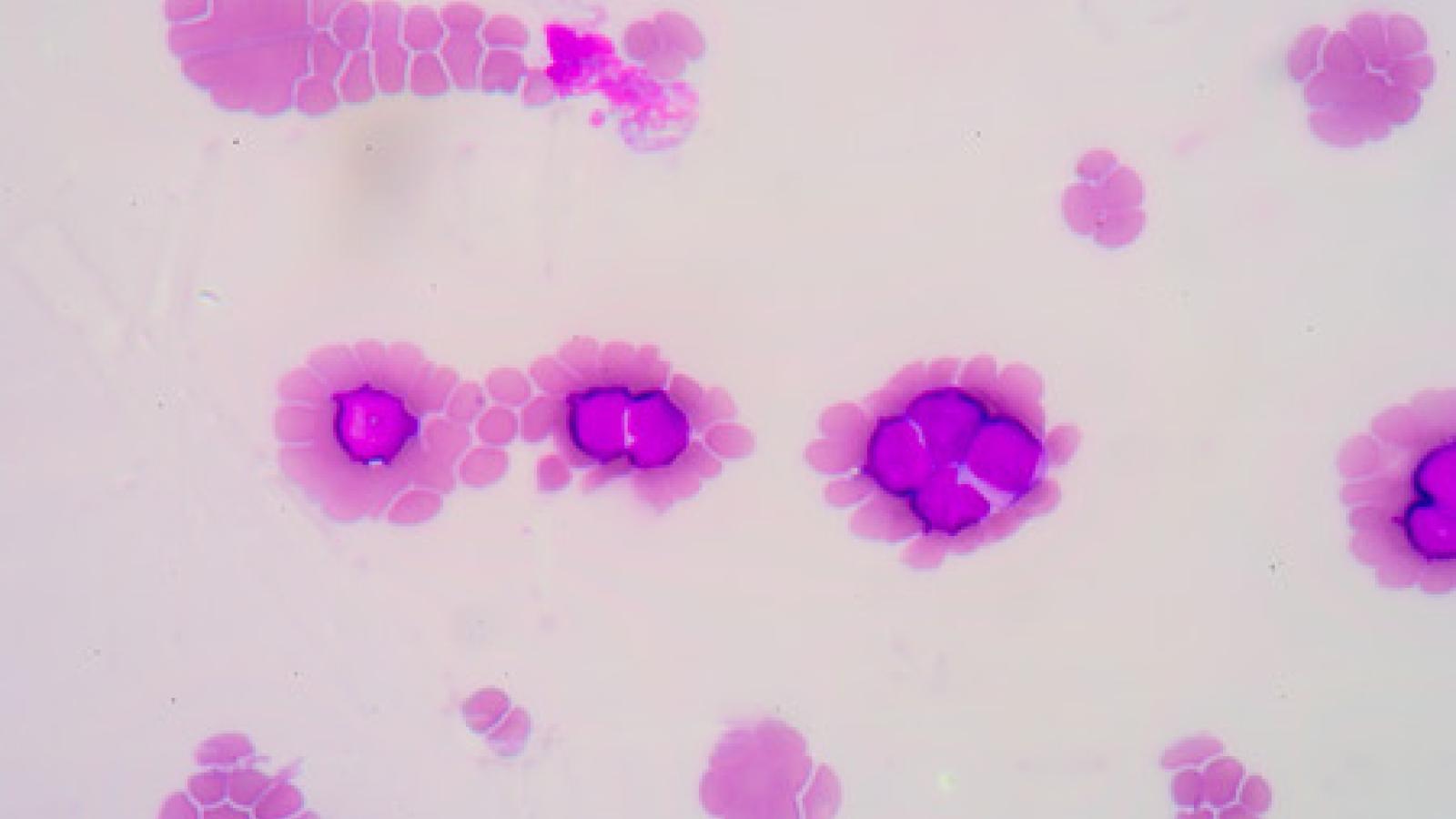 lymphoma.jpg