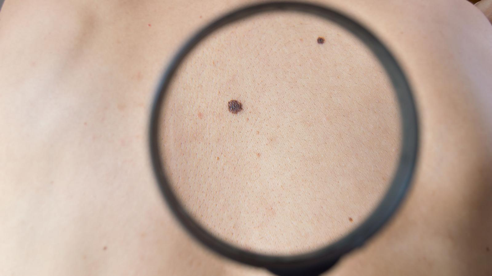 melanoma